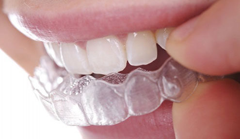 clear_aligner