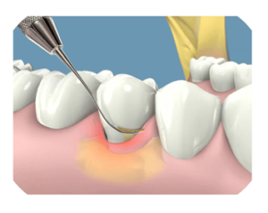 periodencimetro